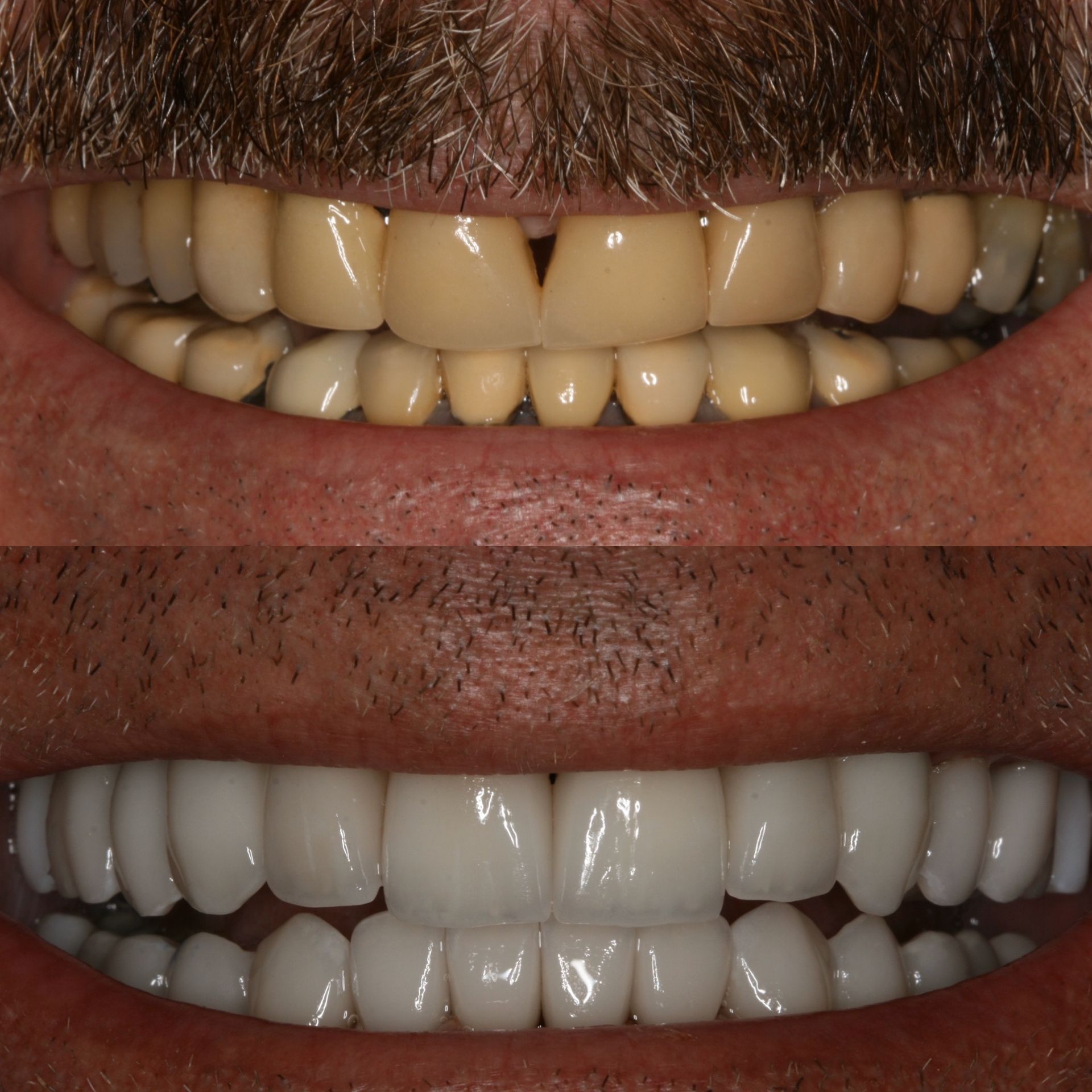 Before-and-after of a person's teeth, showing discoloration and gaps versus bright, white, aligned teeth.