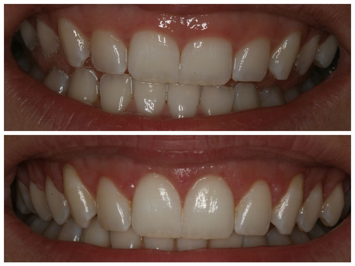 Comparison of teeth before and after dental work, showing whiter, aligned teeth.