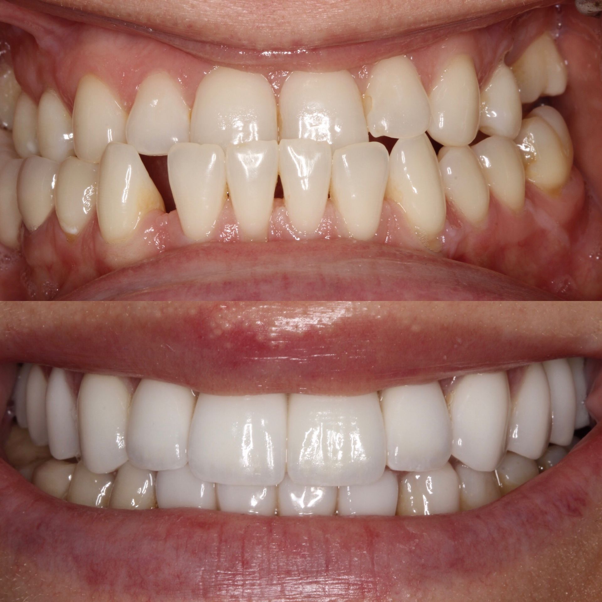 Comparison of teeth: Before, crooked with gaps, and after, straight, white, and full smile.