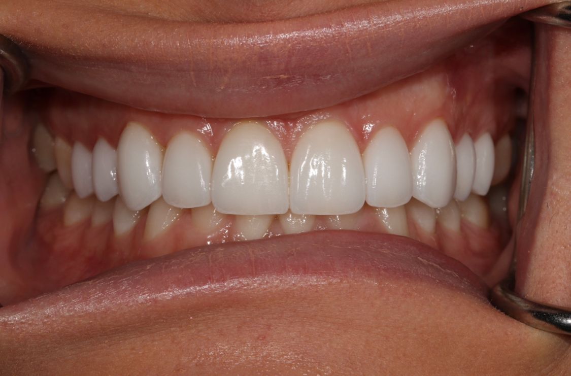 Mouth with bright, white teeth; dental procedure in progress; lips parted, cheek retractors in place.