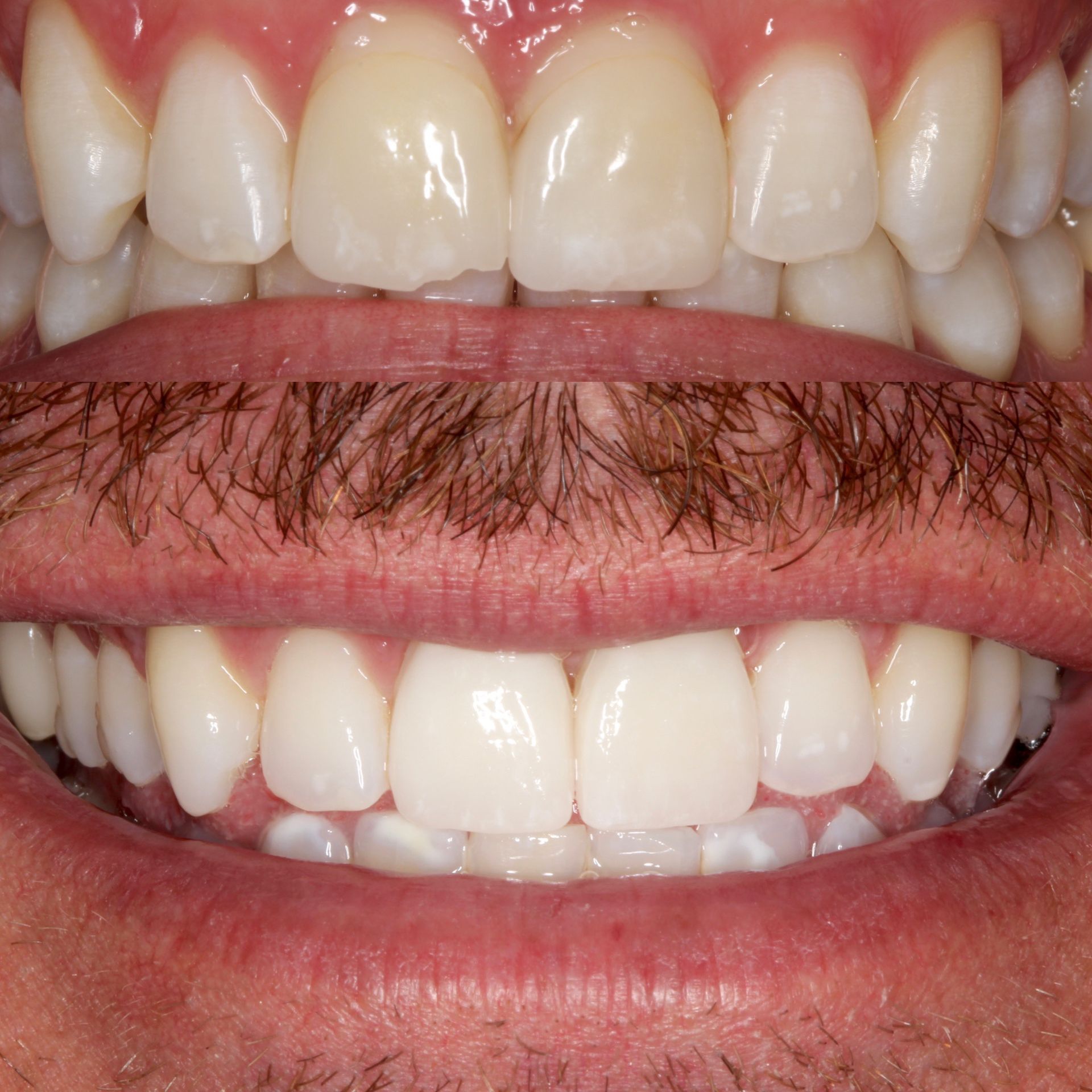 Two sets of teeth, upper and lower rows, smiling. Bright white teeth with healthy gums.