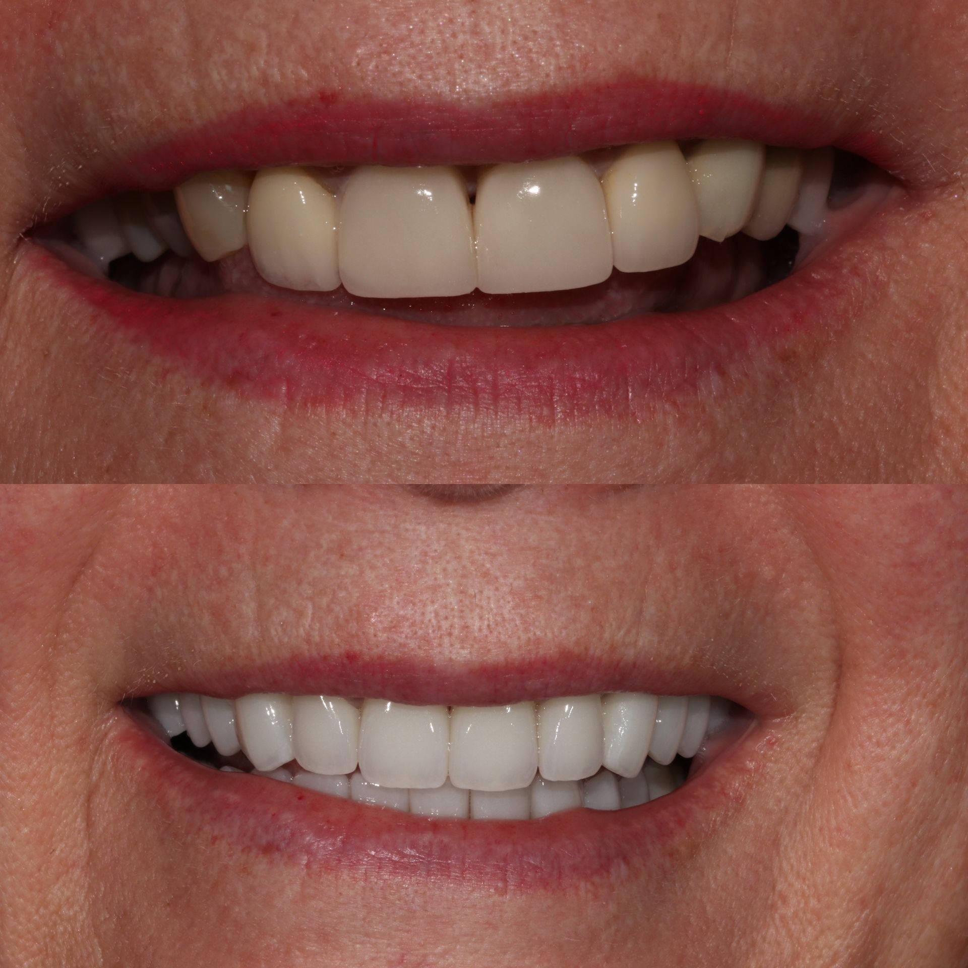 Before and after photos showing teeth whitening, smile transformation.
