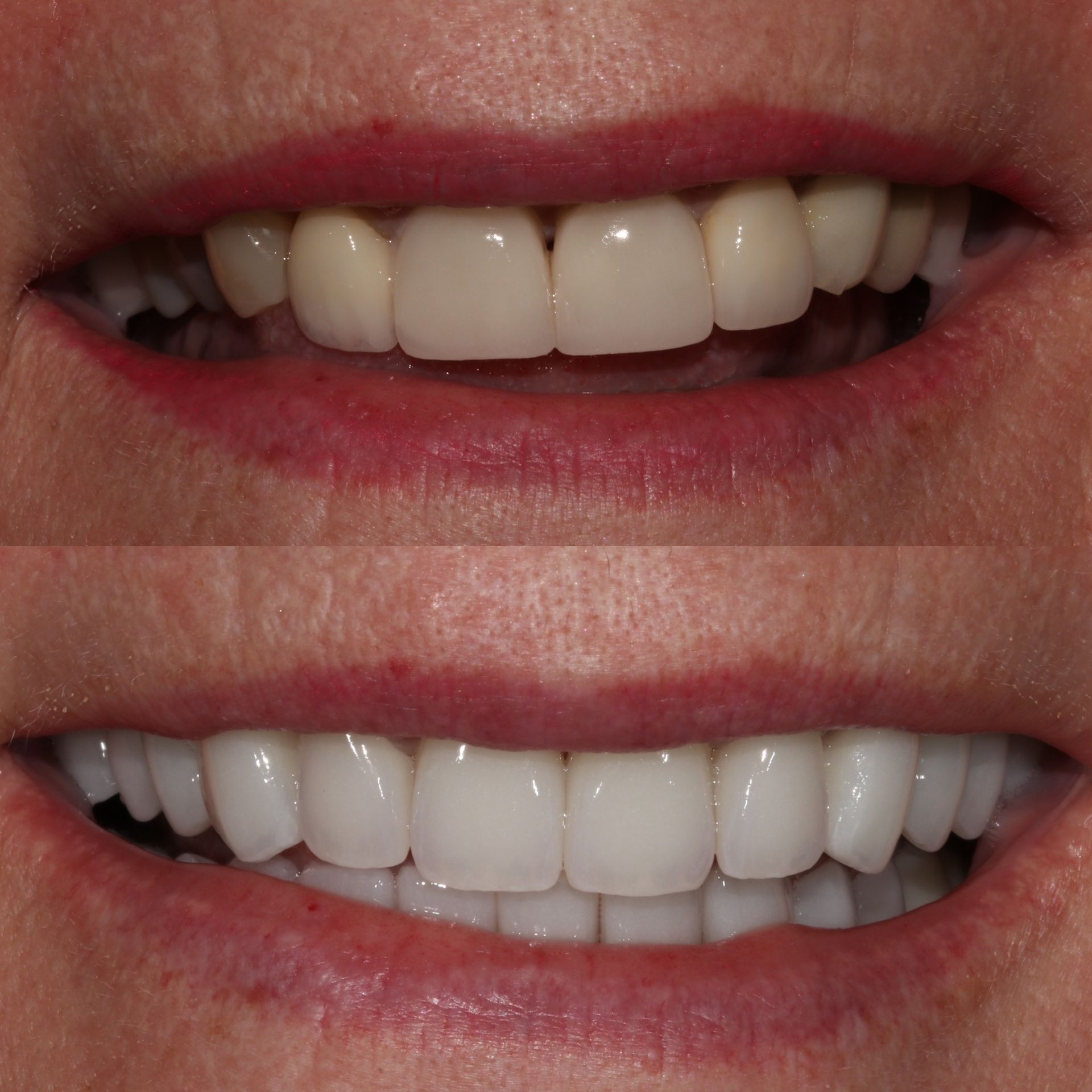 Comparison of teeth: Before, teeth are dull. After, teeth are bright white.