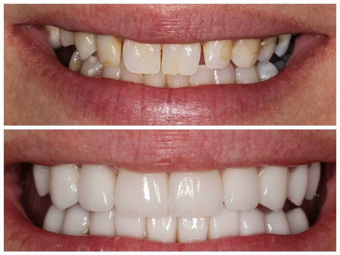 Comparison of teeth: top row shows stained, misaligned teeth; bottom row shows bright, aligned teeth.