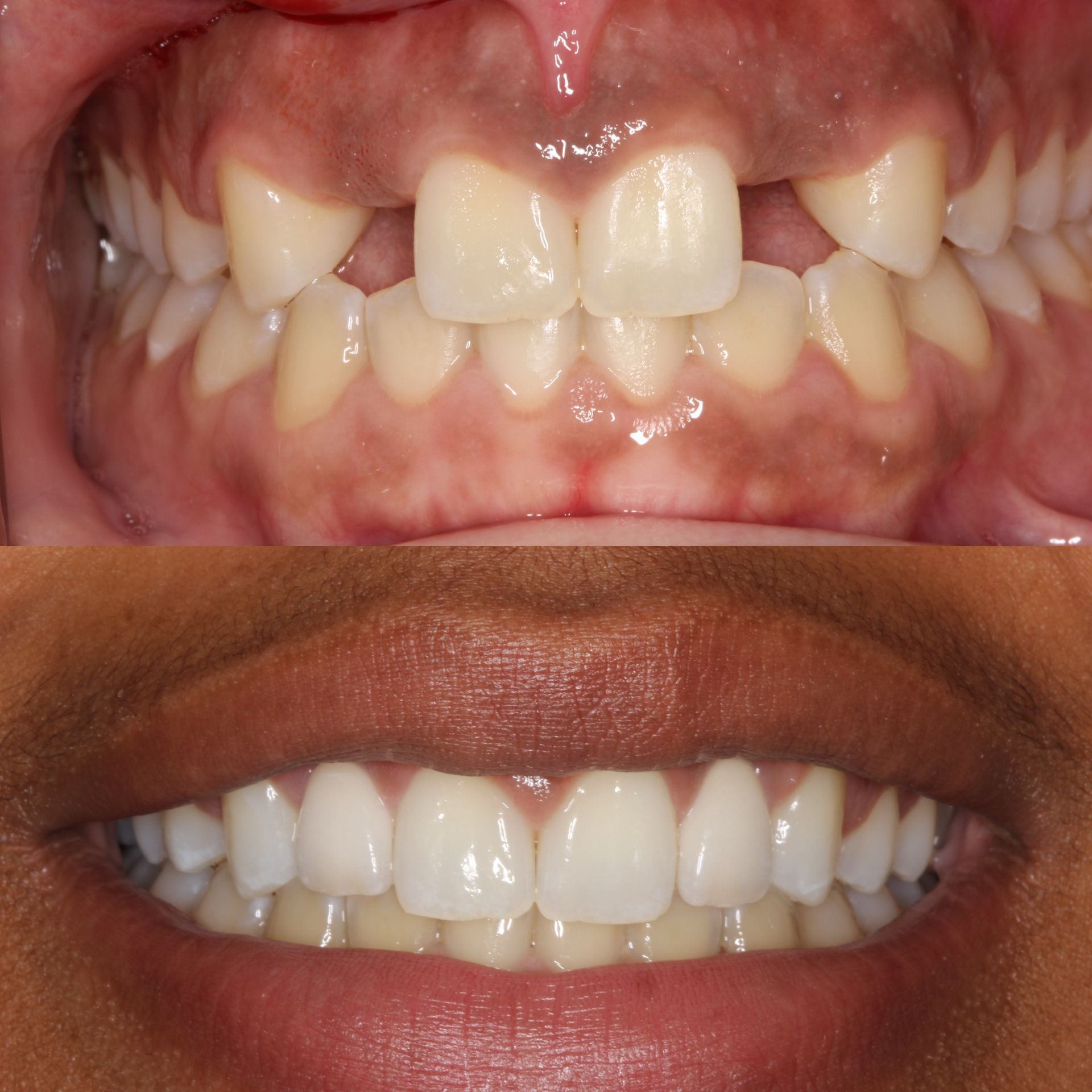 Top: Crooked teeth. Bottom: Straight, white teeth.