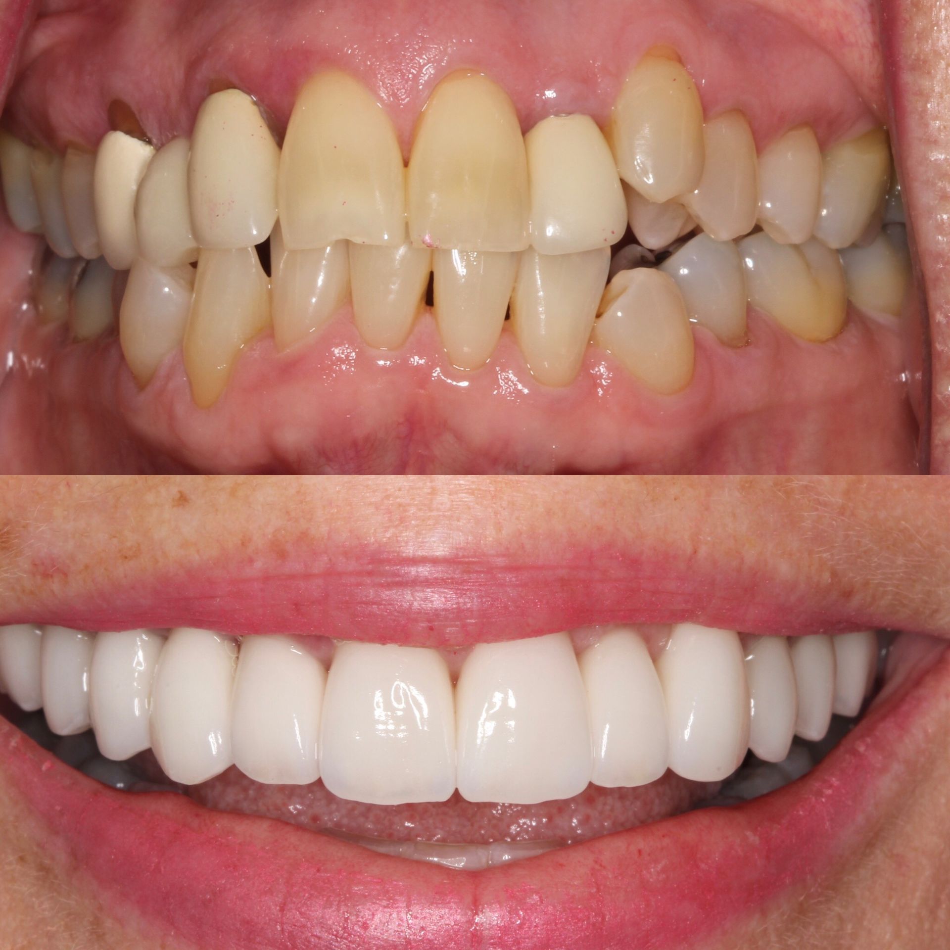 Top: Yellow, crooked teeth. Bottom: Straight, white teeth with a pink smile.