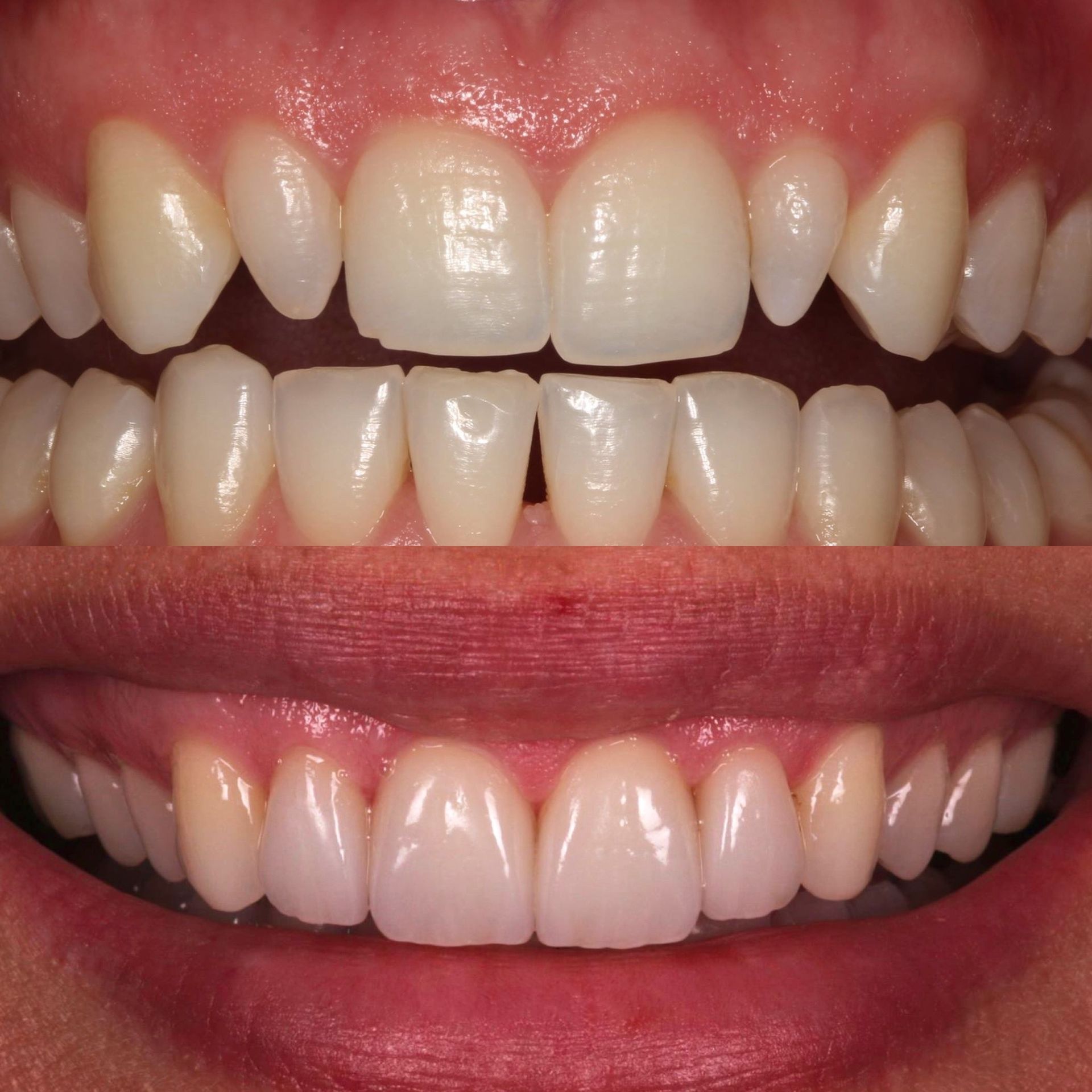 Teeth before and after cosmetic dentistry; white, straight teeth replacing crooked, spaced teeth.
