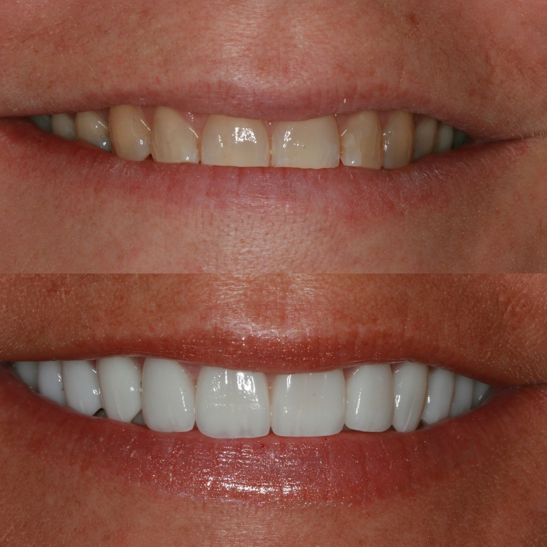 Comparison of a person's teeth before and after a cosmetic dental procedure; teeth are whiter and more even in the after photo.