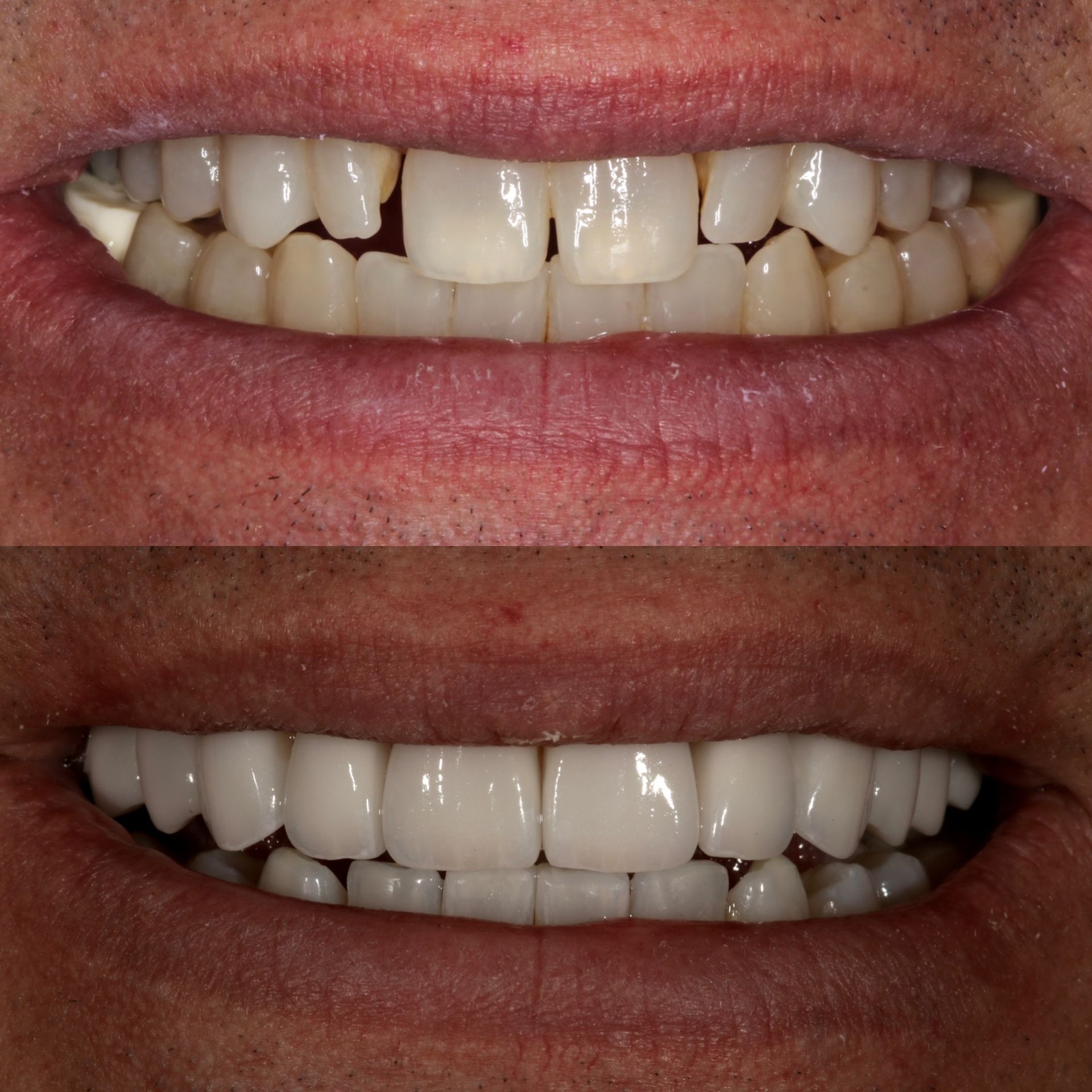Comparison of teeth before and after cosmetic dental work, revealing straighter, whiter teeth.