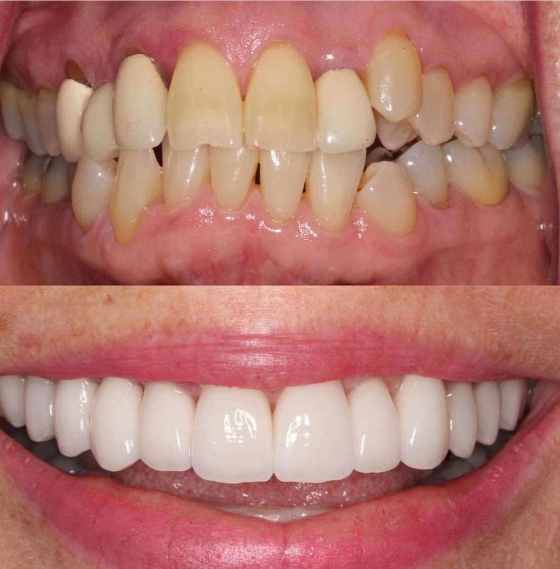 Top: teeth before cosmetic work; yellowed and misaligned. Bottom: after; bright white and even.