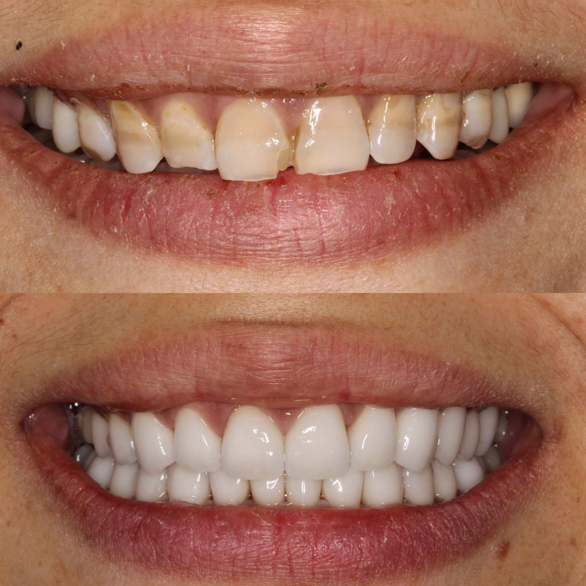 Before and after comparison: stained and damaged teeth versus bright, white smile.