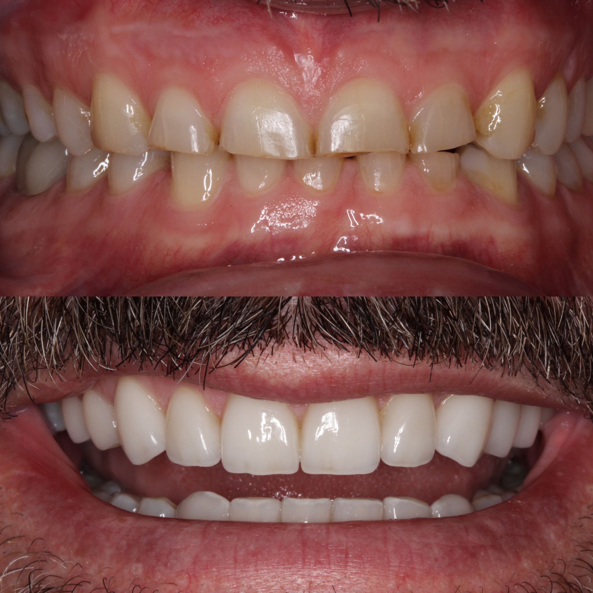 Comparison: Before and after of teeth, showing improvement in color, shape, and alignment after a dental procedure.