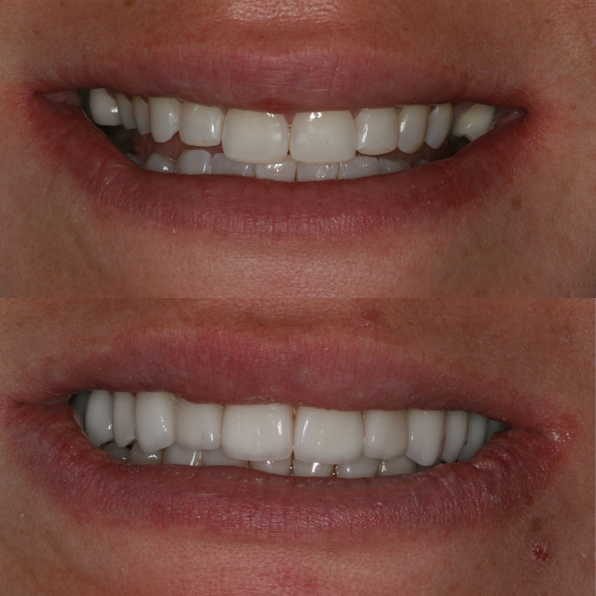 Before-and-after of a smile. Top: teeth before; bottom: straight, white teeth after dental work.