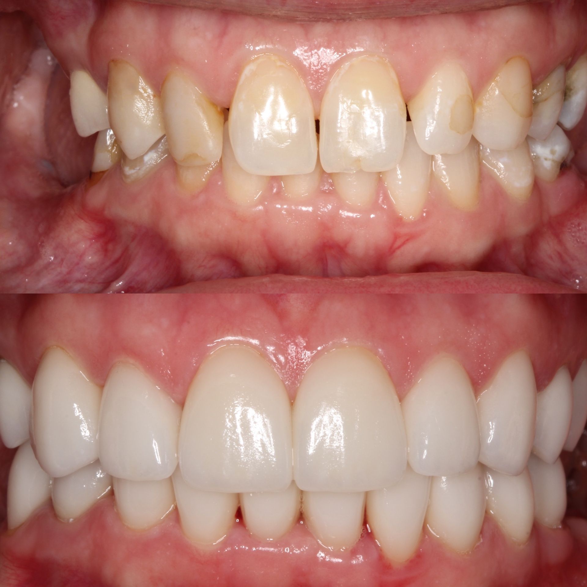Before and after dental photo: top row shows stained, misaligned teeth; bottom row shows bright, aligned teeth.