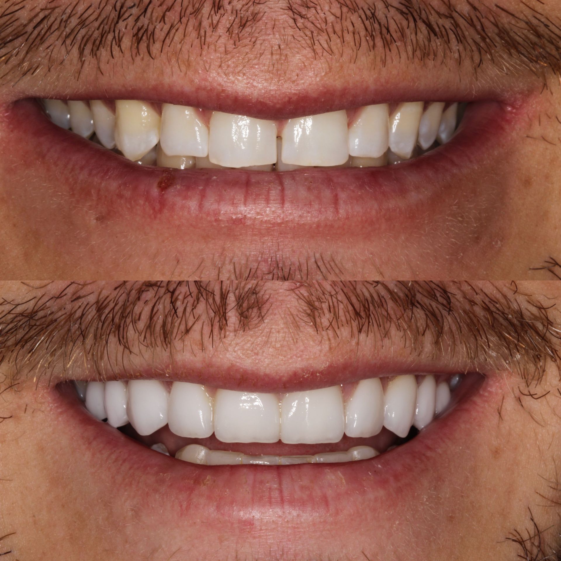 Comparison of teeth before and after cosmetic dental work, showing a wider, whiter smile.