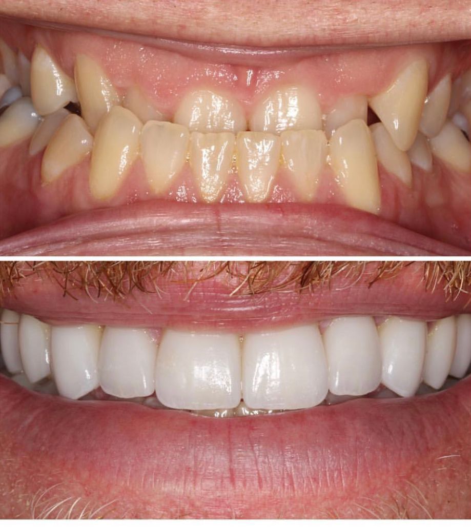 Side-by-side comparison of teeth. Top row: misaligned, yellow teeth. Bottom row: straight, white teeth.