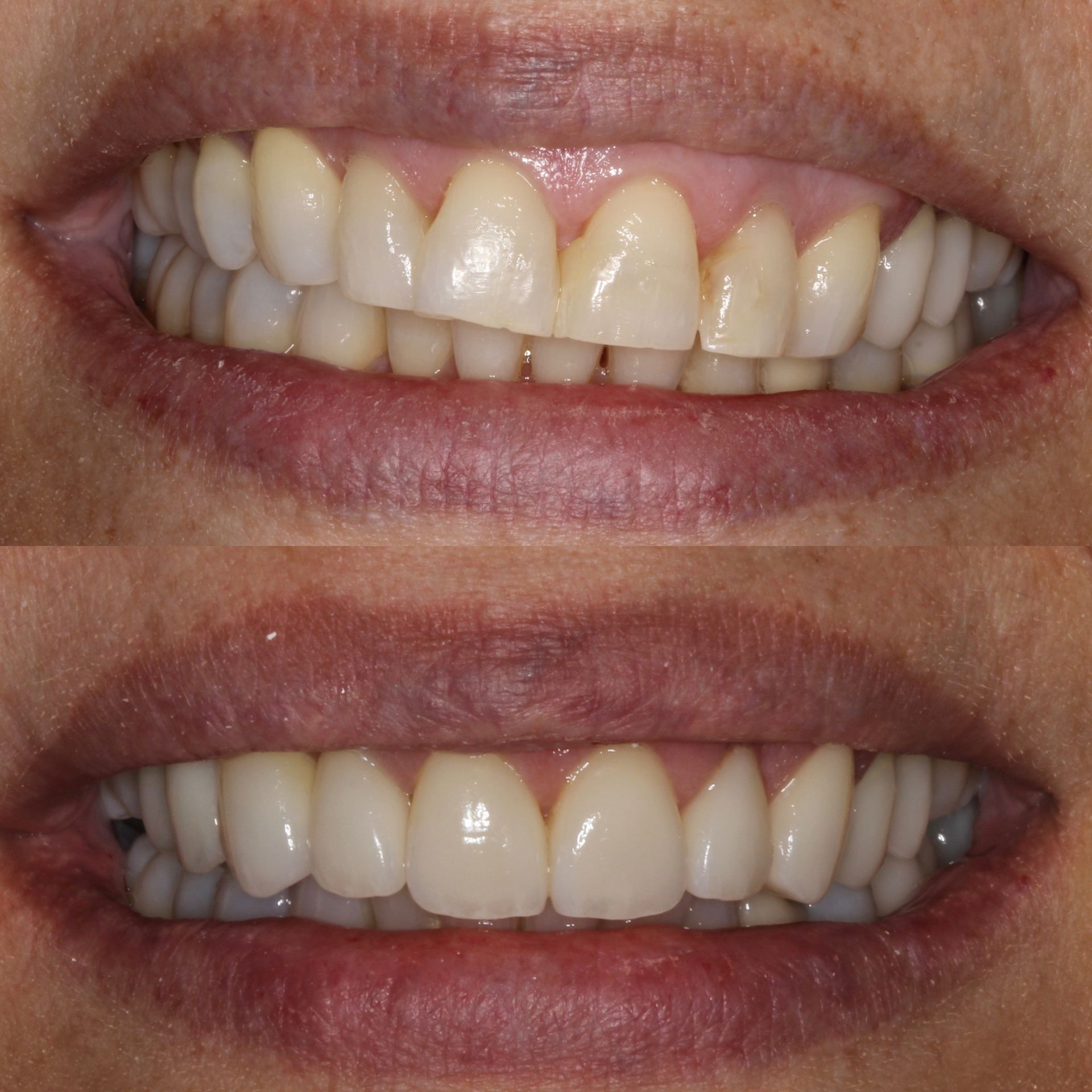Comparison of teeth before and after dental work, showing a brighter, more even smile.
