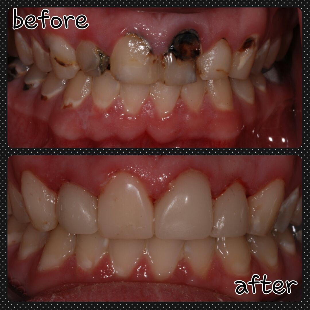 Top shows decayed teeth. Bottom shows the repaired teeth with white crowns.