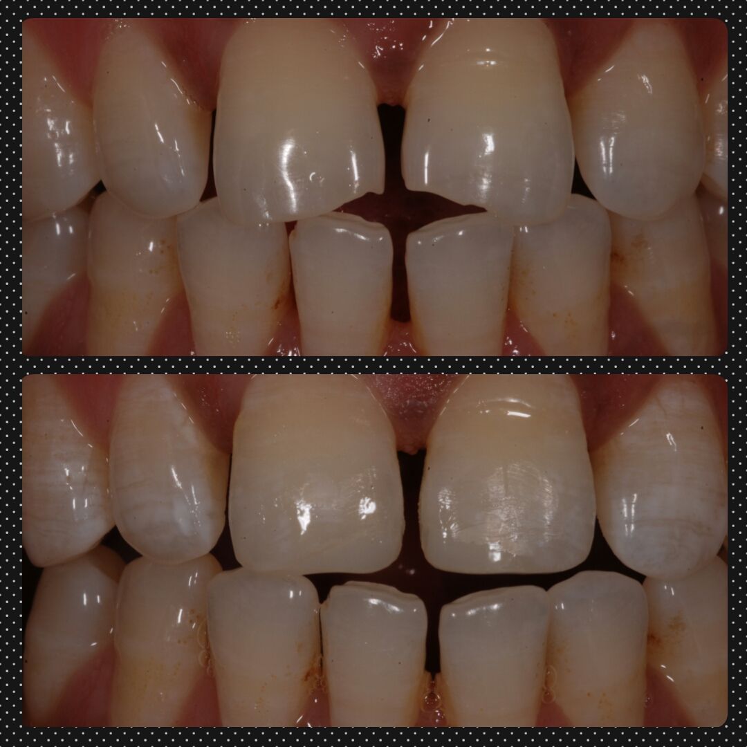 Two close-up views of teeth: top row shows a gap; bottom row, same teeth, gap closed.