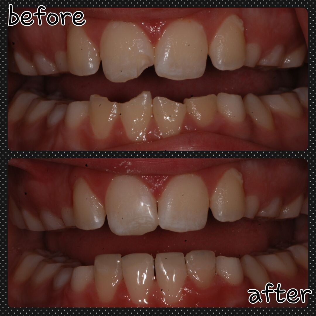 Top: Before, cracked teeth. Bottom: After, repaired teeth with filling.