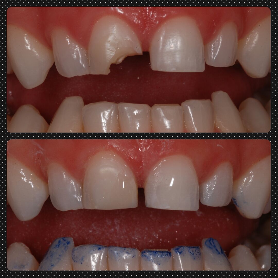 Two images show a chipped front tooth repaired with composite bonding, before and after.