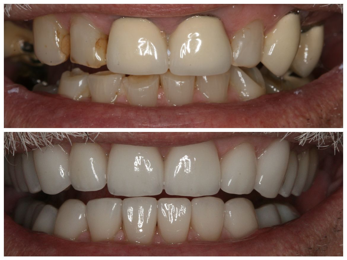 Before and after view of teeth. Top: stained and damaged teeth. Bottom: bright, white teeth.