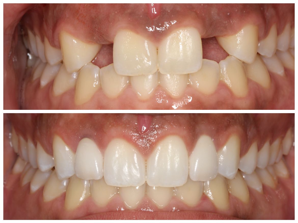 Before and after photos of teeth. The top shows gapped, misaligned teeth; the bottom shows straight, aligned teeth.