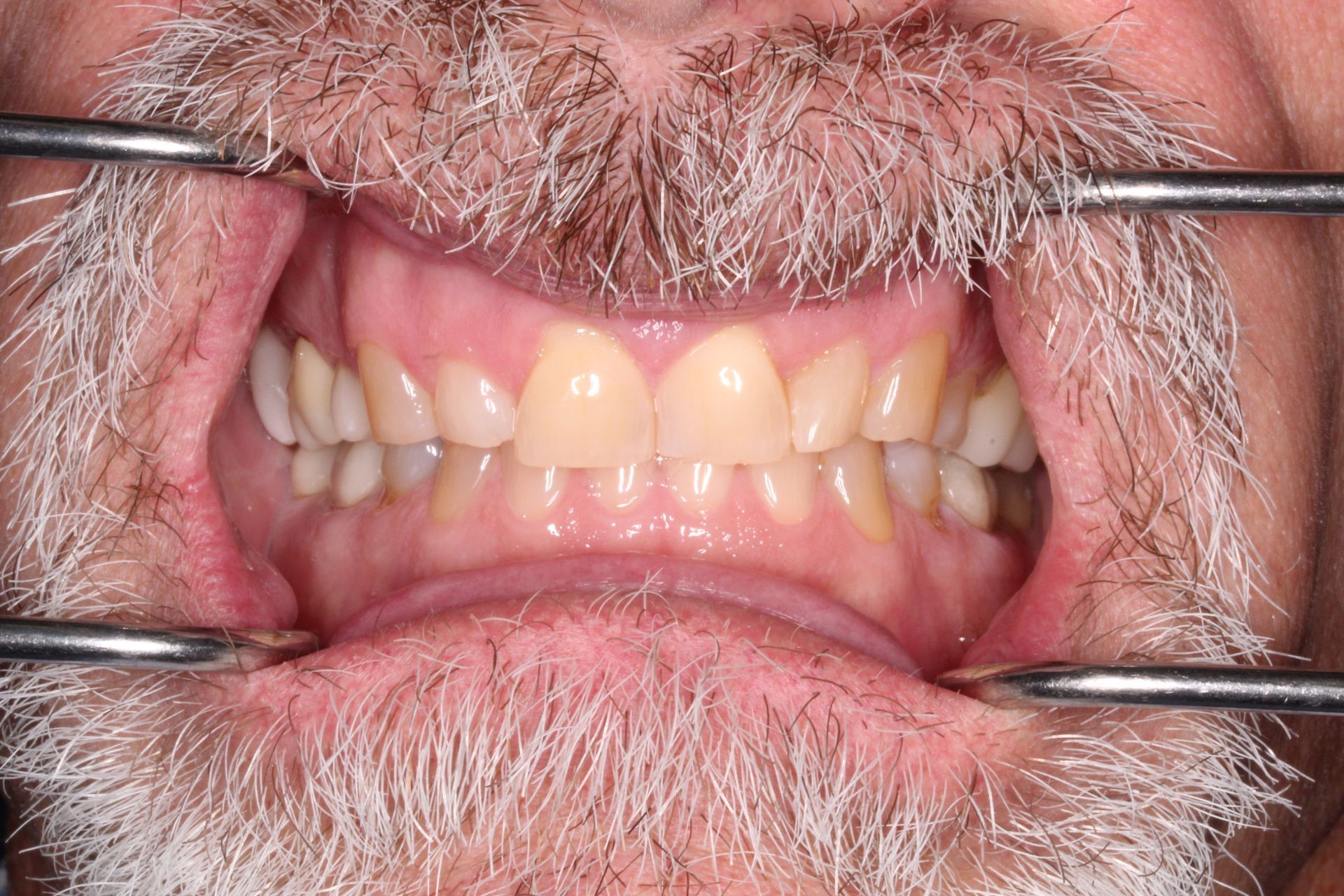 Mouth open, showing teeth. A beard surrounds the mouth. Metal retractors hold the mouth open.