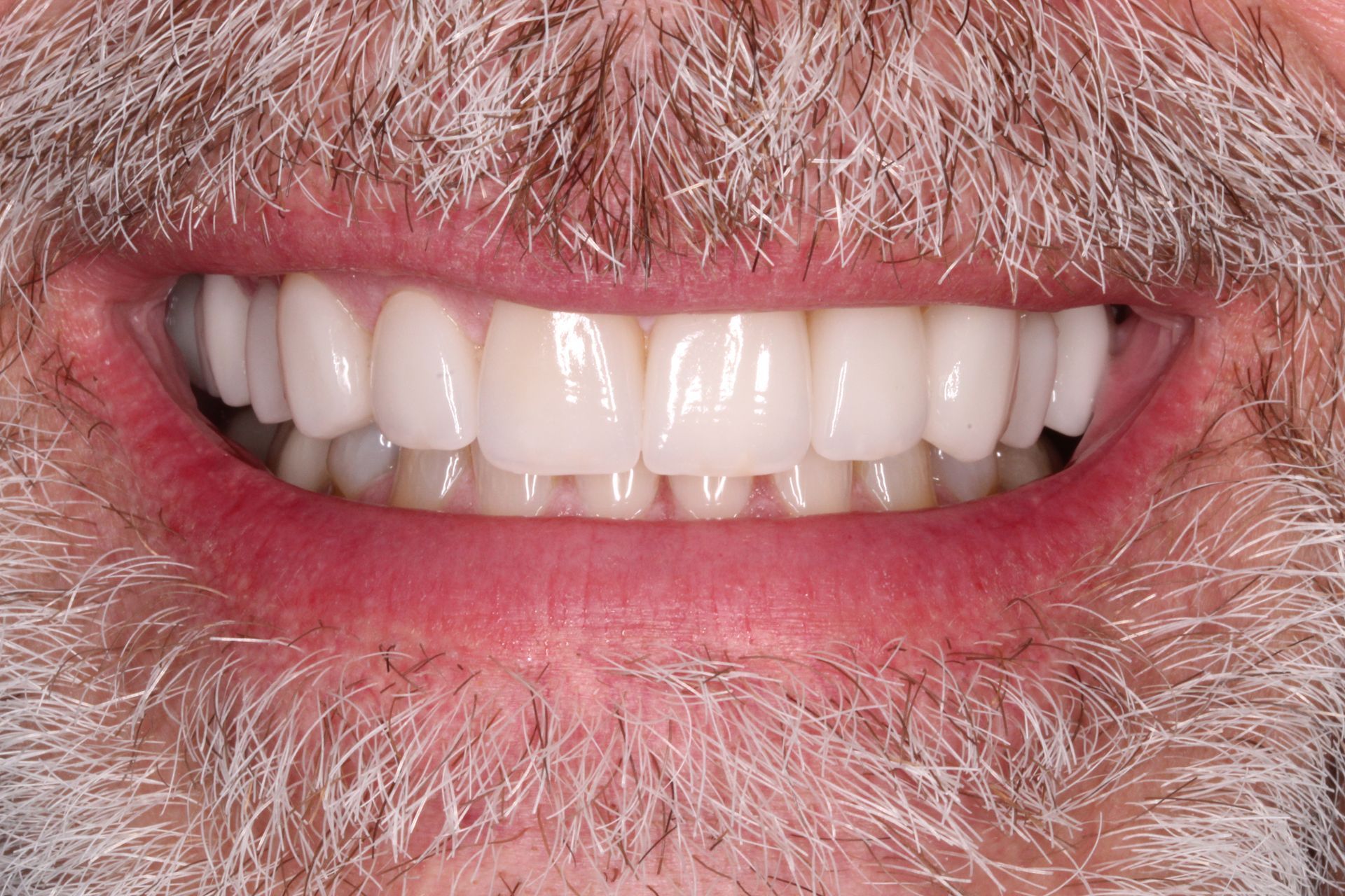 Close-up of a smiling mouth with bright, white teeth, set against a background of a beard and lips.