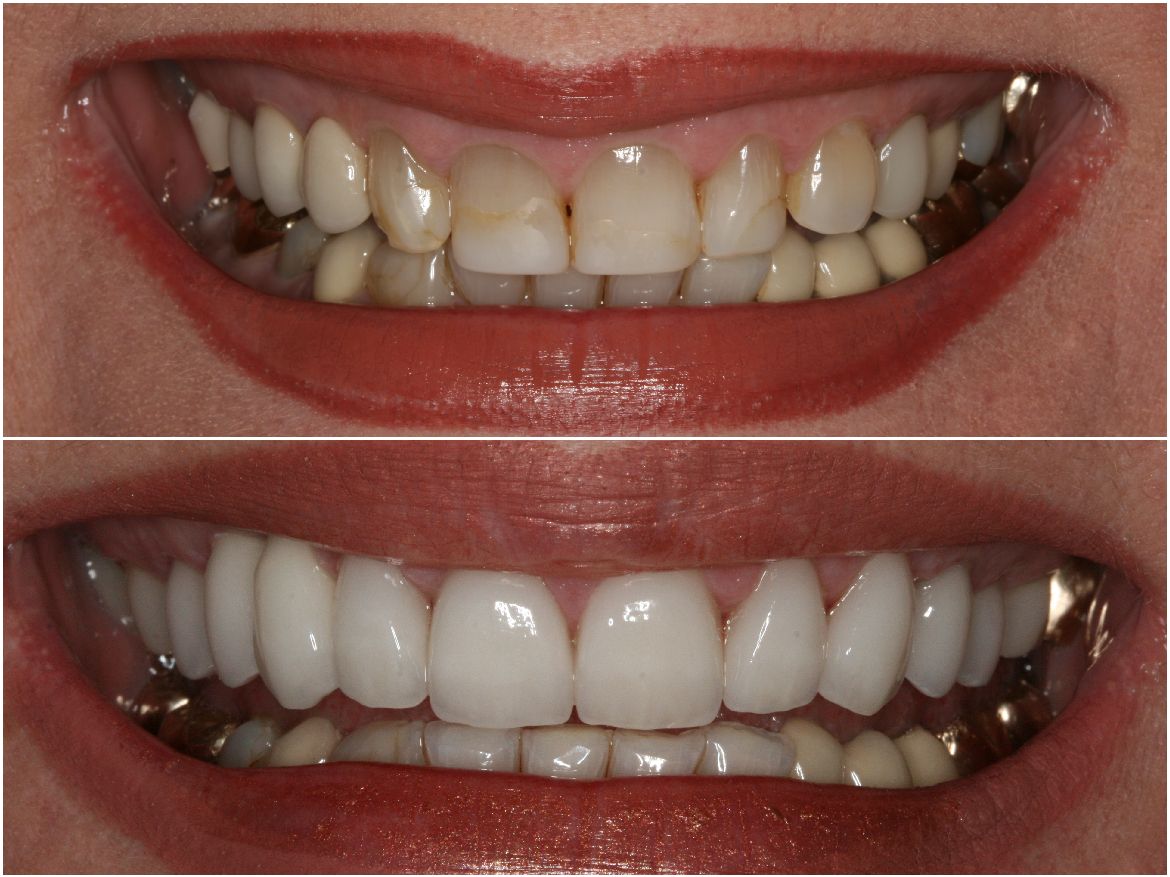 Before and after comparison of teeth. Upper image: stained teeth. Lower image: bright, white teeth.