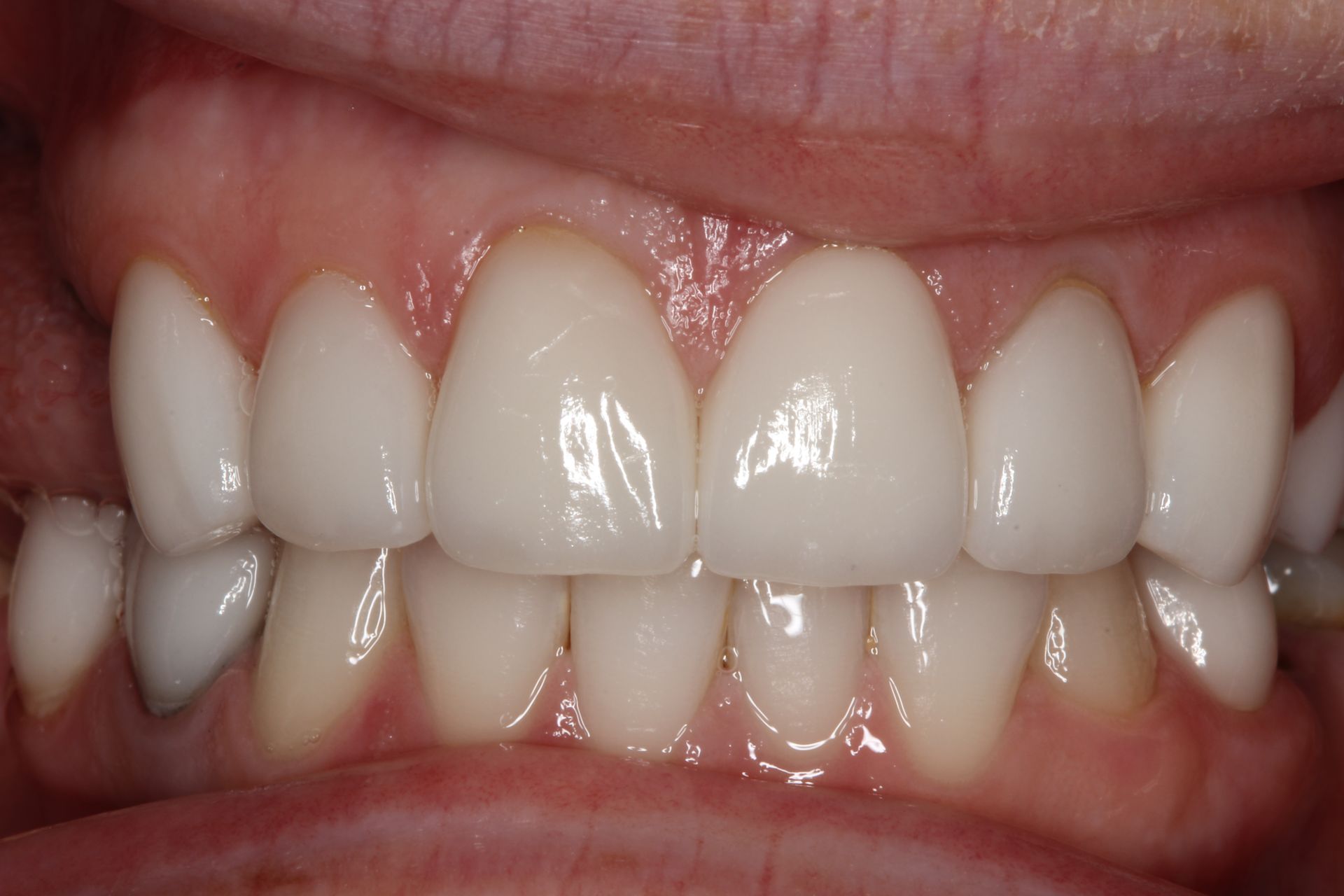 Close-up of a person's teeth. They are white, even, and well-aligned. The gums are healthy-looking.
