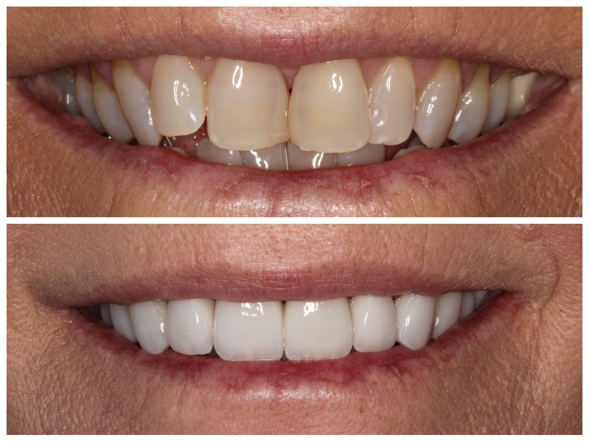 Before and after of a smile showing discolored teeth improving to a bright, white smile.
