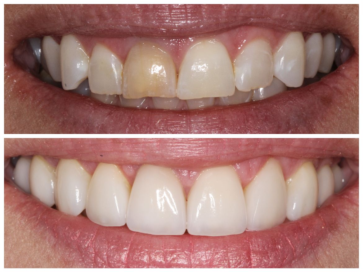 Comparison of two sets of teeth, before and after a dental procedure. The bottom teeth appear whiter.