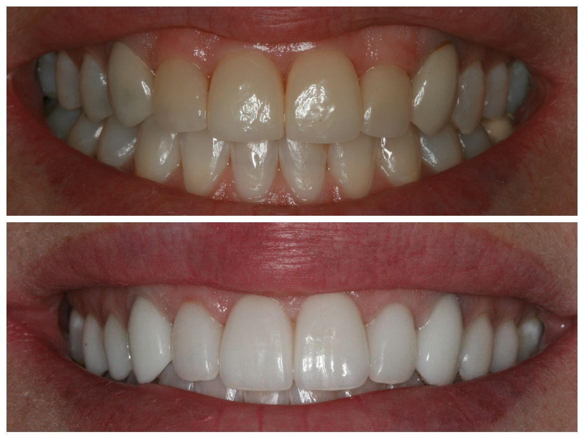 Comparison of teeth before and after cosmetic dental work, showing whiter, aligned teeth.