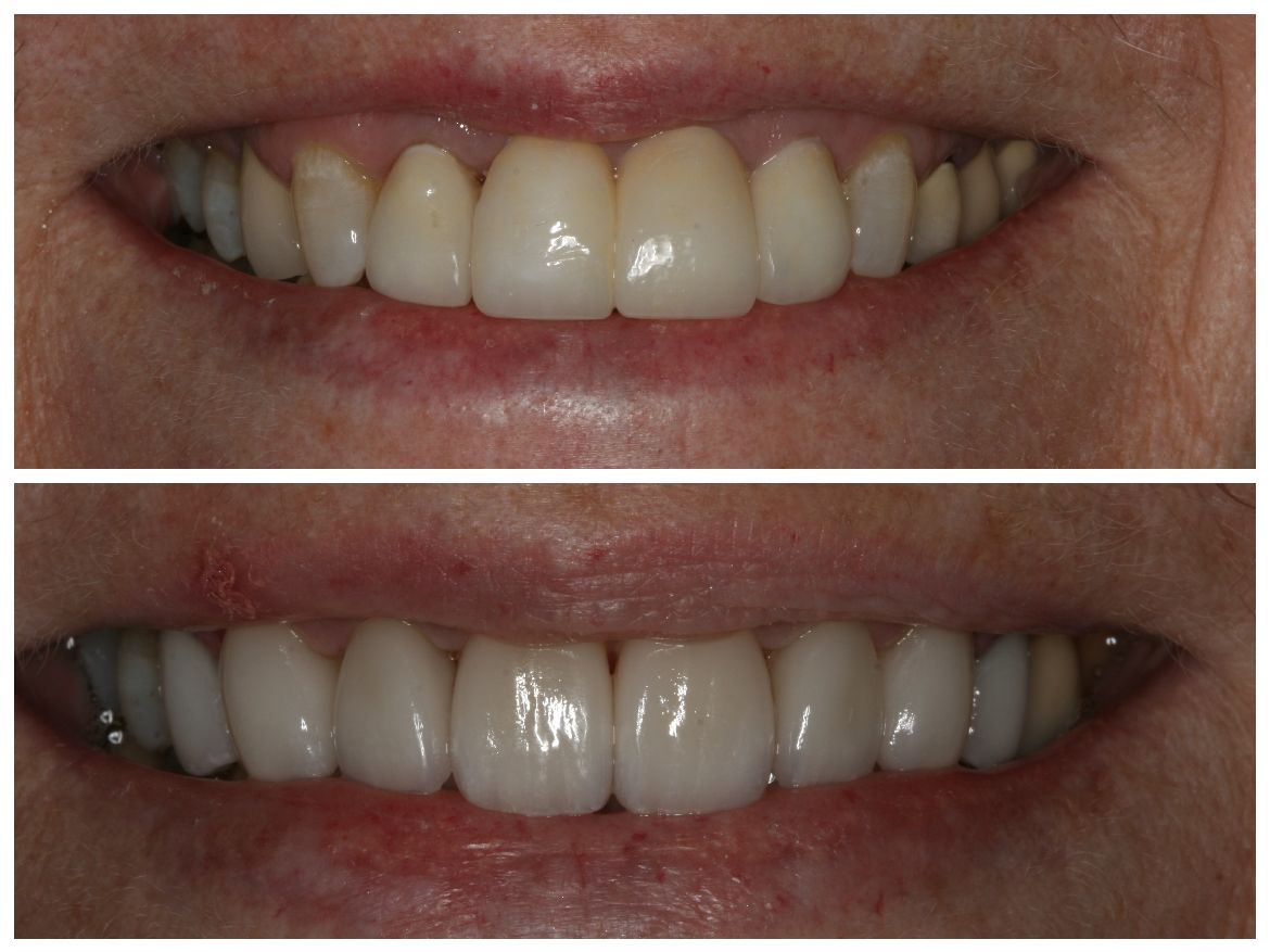 Before and after photos showing teeth; the after photo displays a brighter, more even smile.