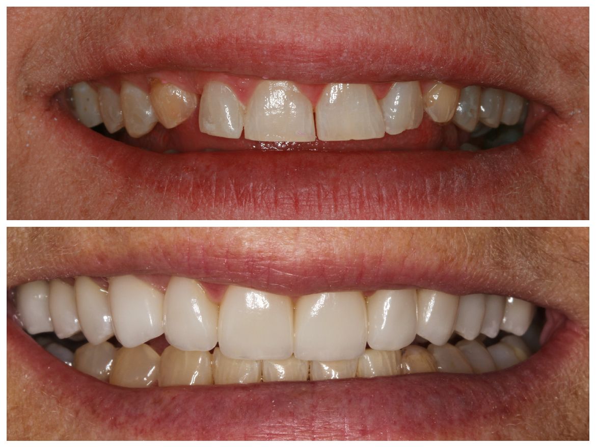 Before and after photos of a person's teeth, showing a whitening and straightening transformation.