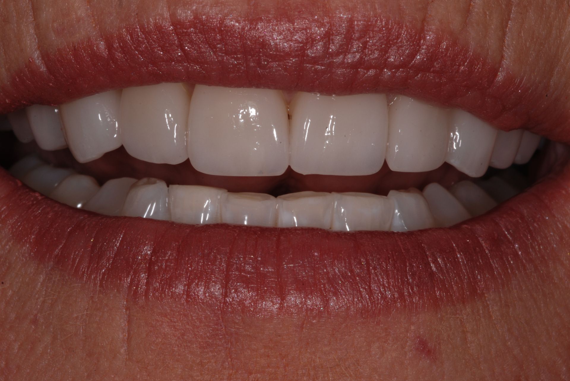 Close-up of a person's smiling mouth showing bright white teeth and red lipstick.