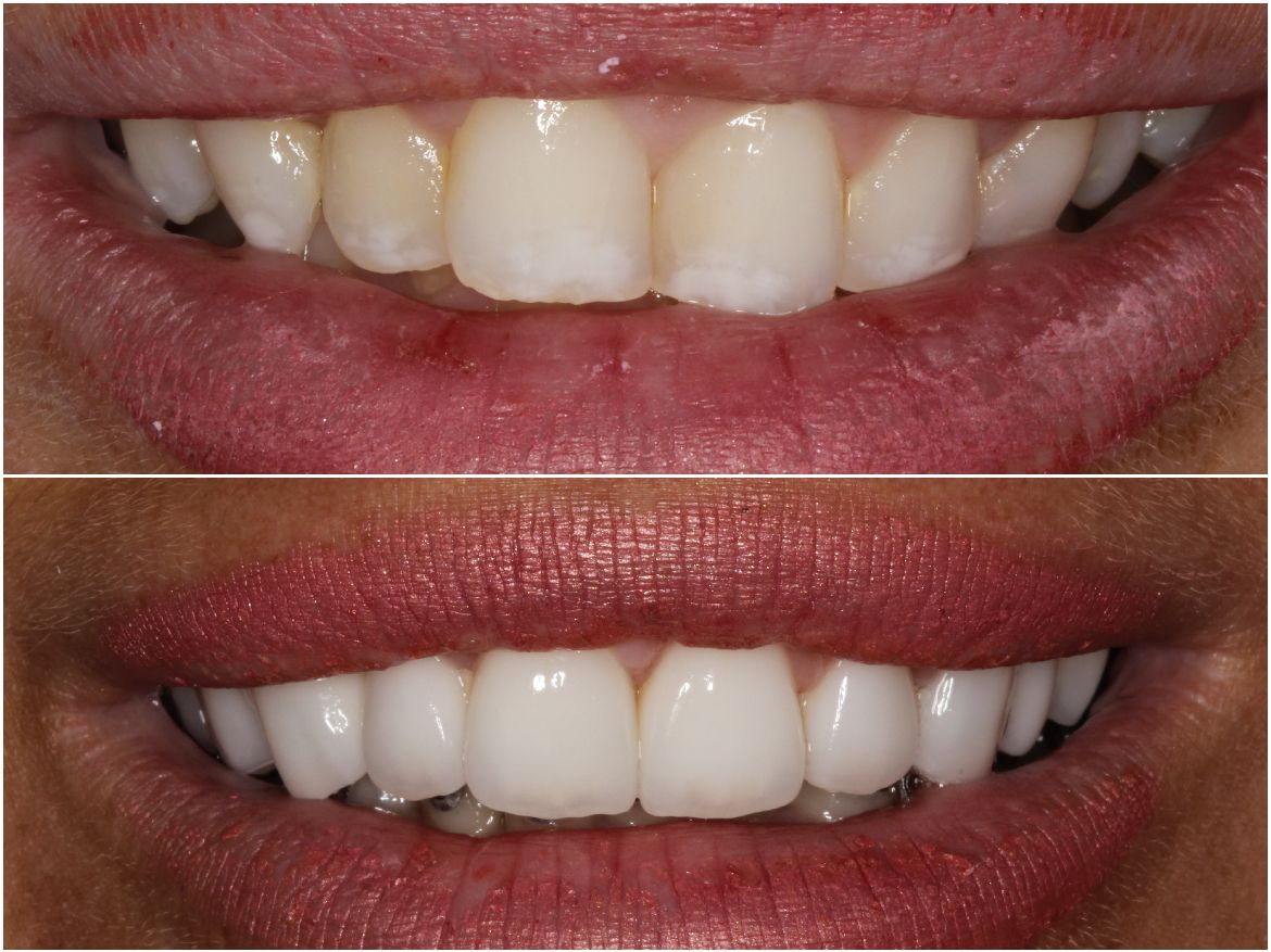 Side-by-side comparison: yellowed teeth before, replaced with bright white, straight teeth after.