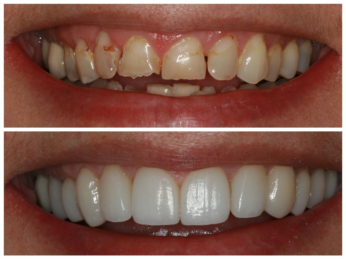 Before-and-after of a person's teeth, showing improvement in shape, color, and alignment after dental work.