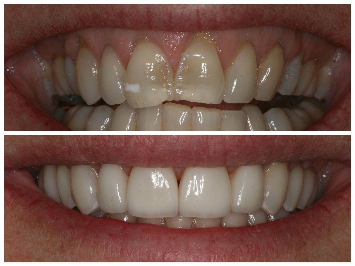 Teeth before and after cosmetic dentistry; showing stained and cracked teeth transformed to a bright, white smile.