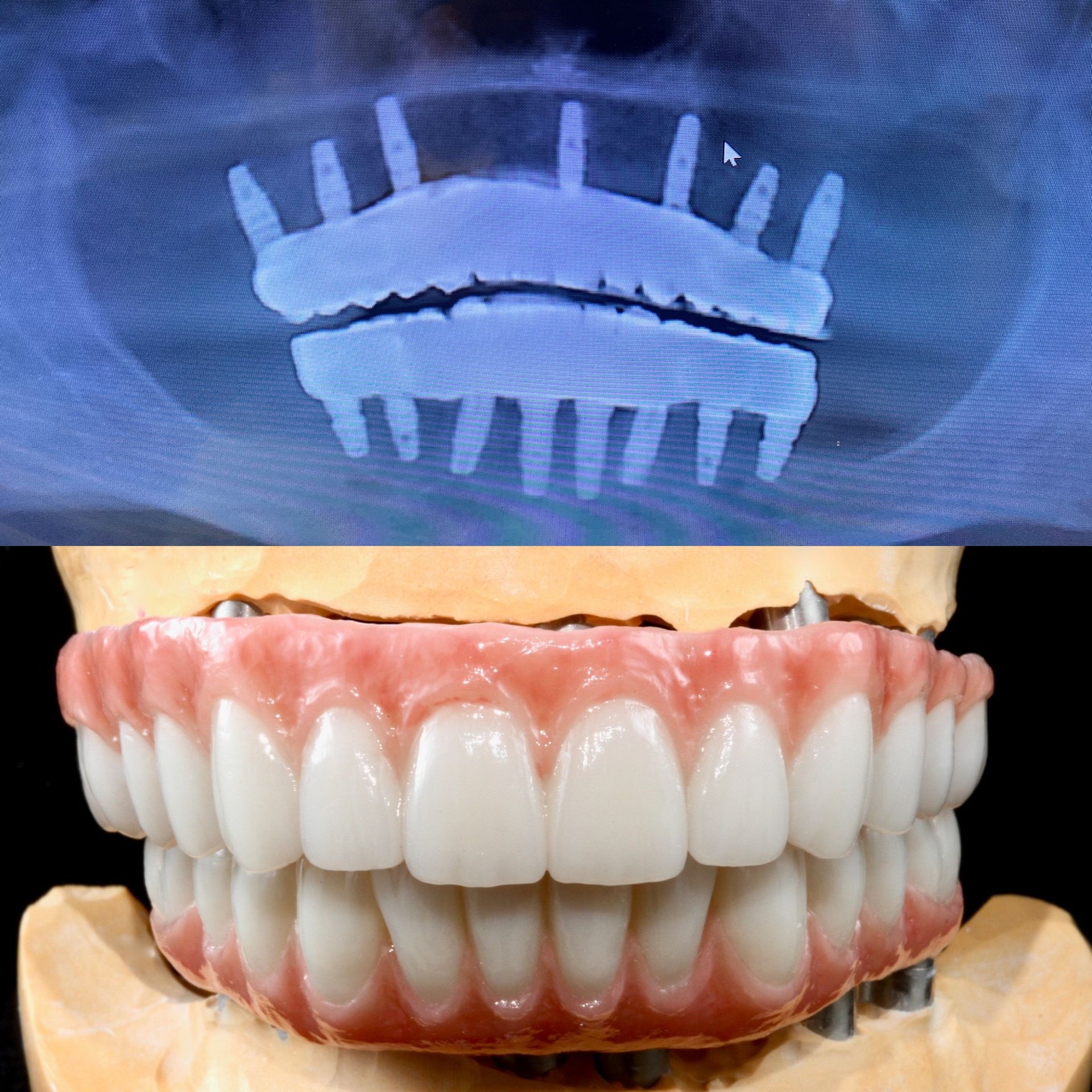 X-ray and model of dental implants and dentures, showing placement and final appearance.