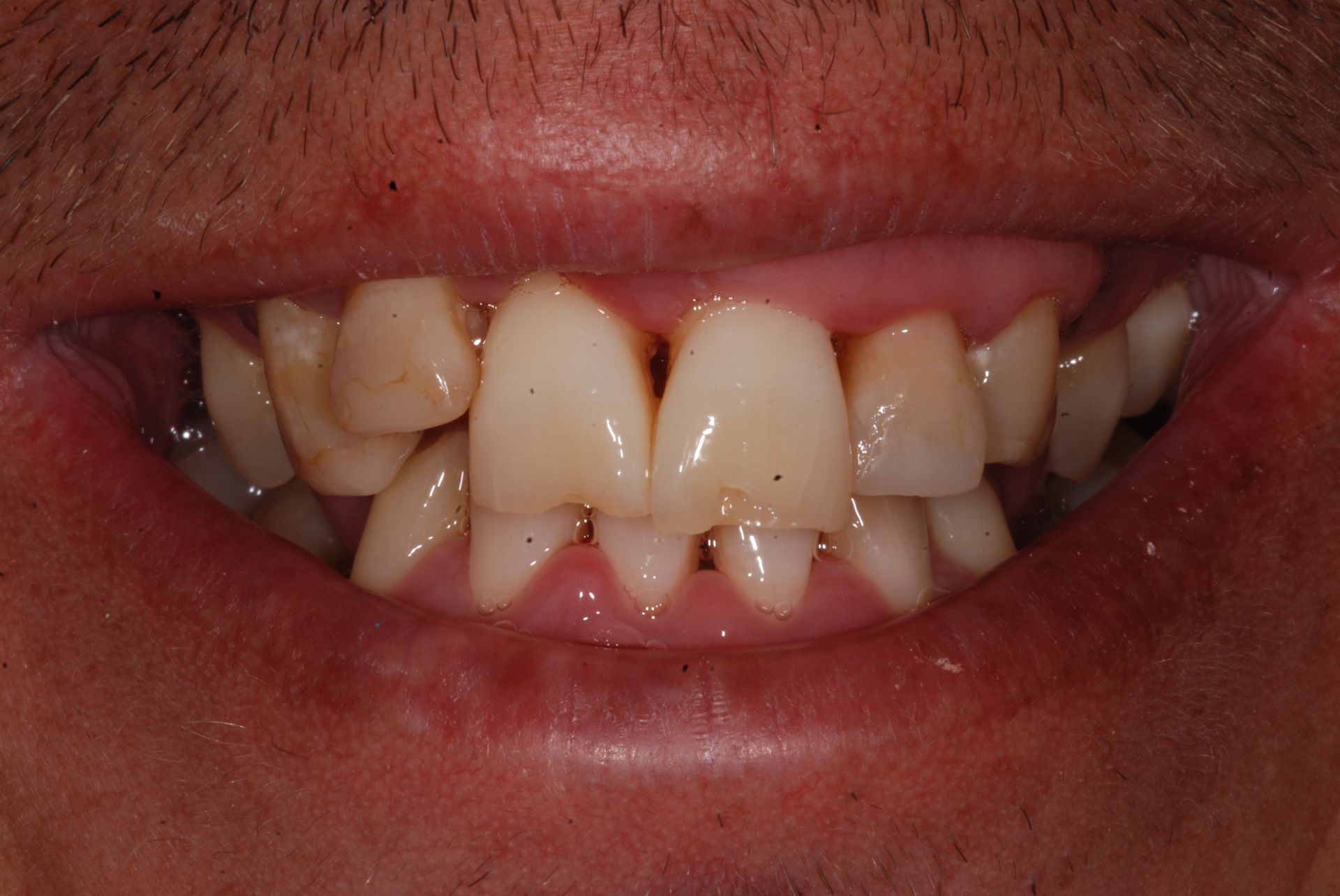 Close-up of a person's teeth, showing discoloration and some chipped teeth. Lips are slightly open.