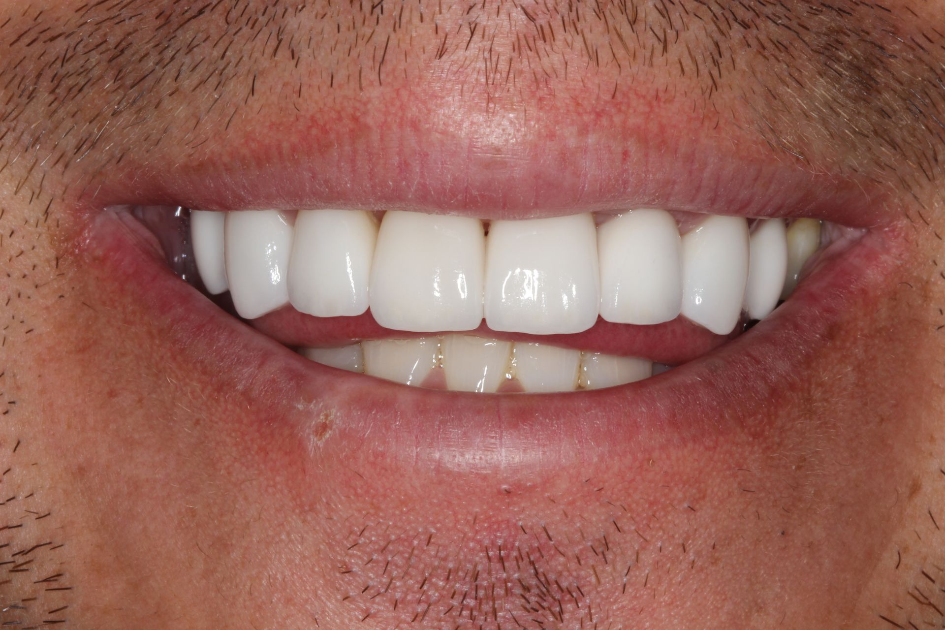 Close-up of person smiling, showing bright white, evenly spaced teeth.