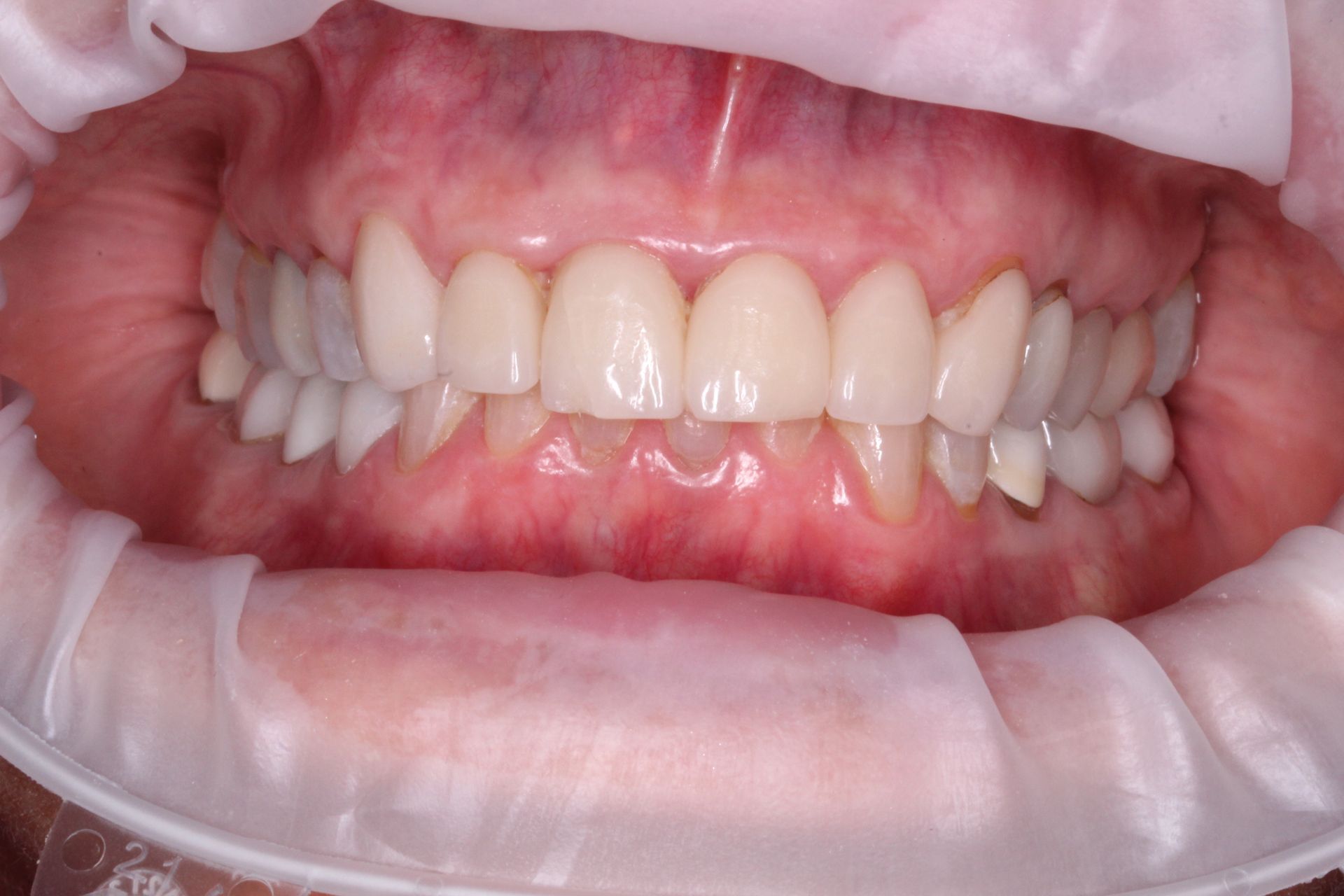 Mouth open showing teeth, gums, and oral cavity; dental examination in progress.