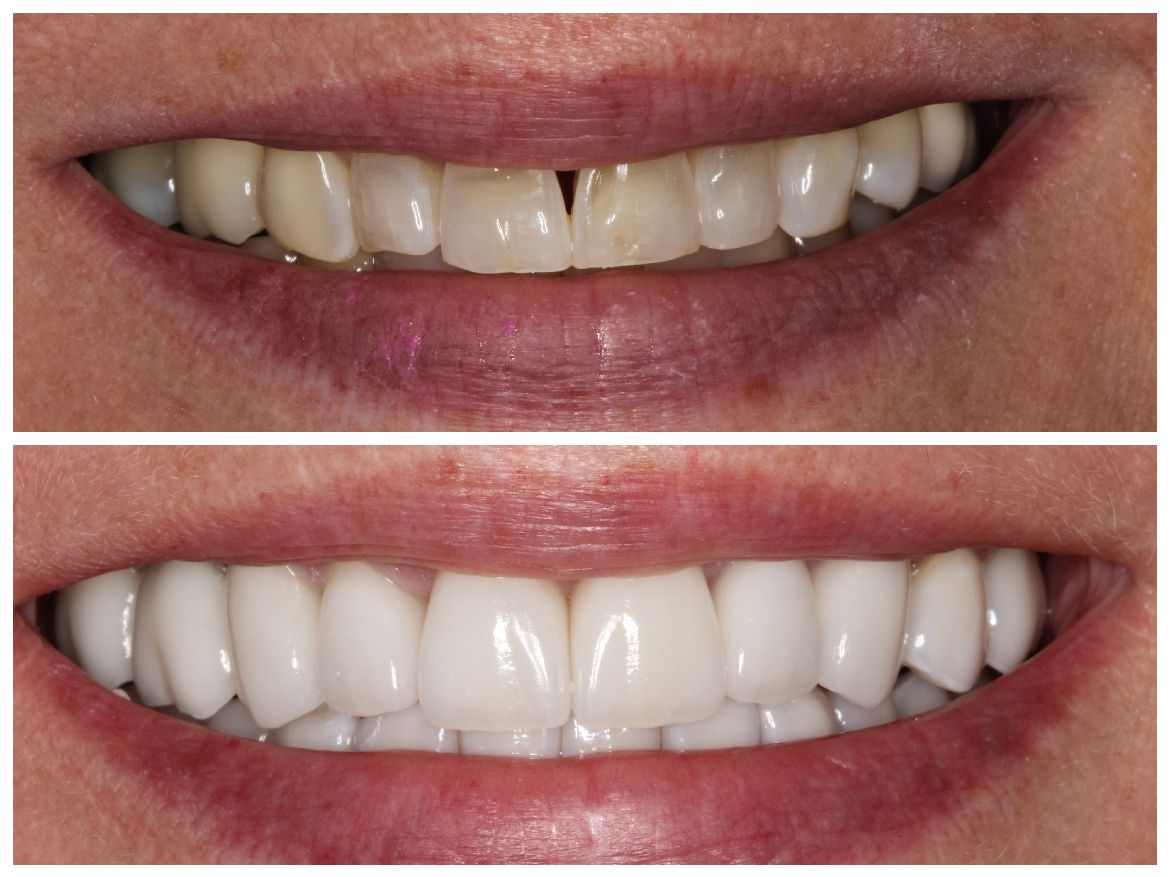 Before and after shots of a person's smile. Top: crooked teeth with a gap. Bottom: straight, bright white teeth.