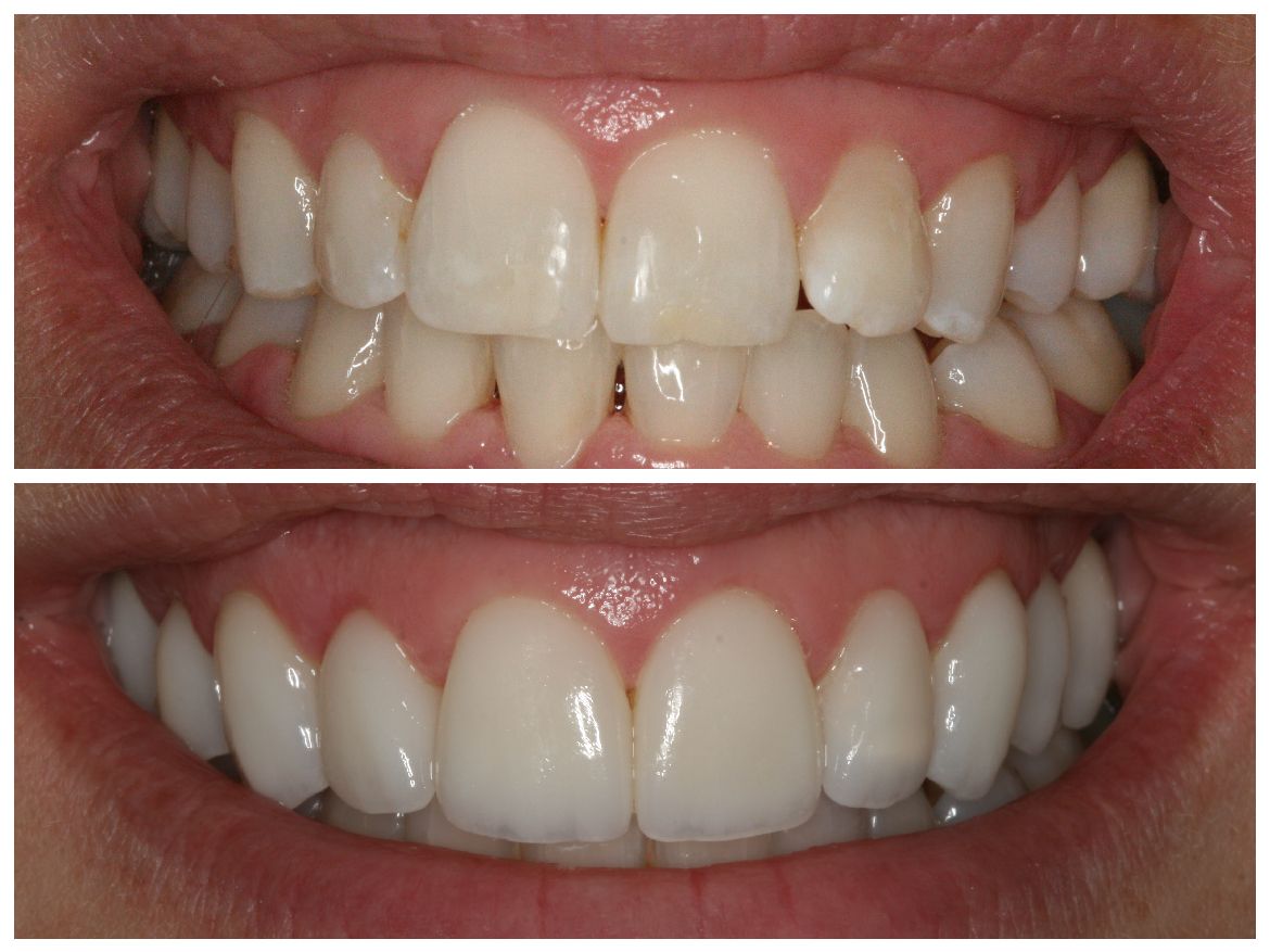 Side-by-side comparison of teeth. Top row: teeth with gaps and discoloration. Bottom row: brighter, straighter teeth.