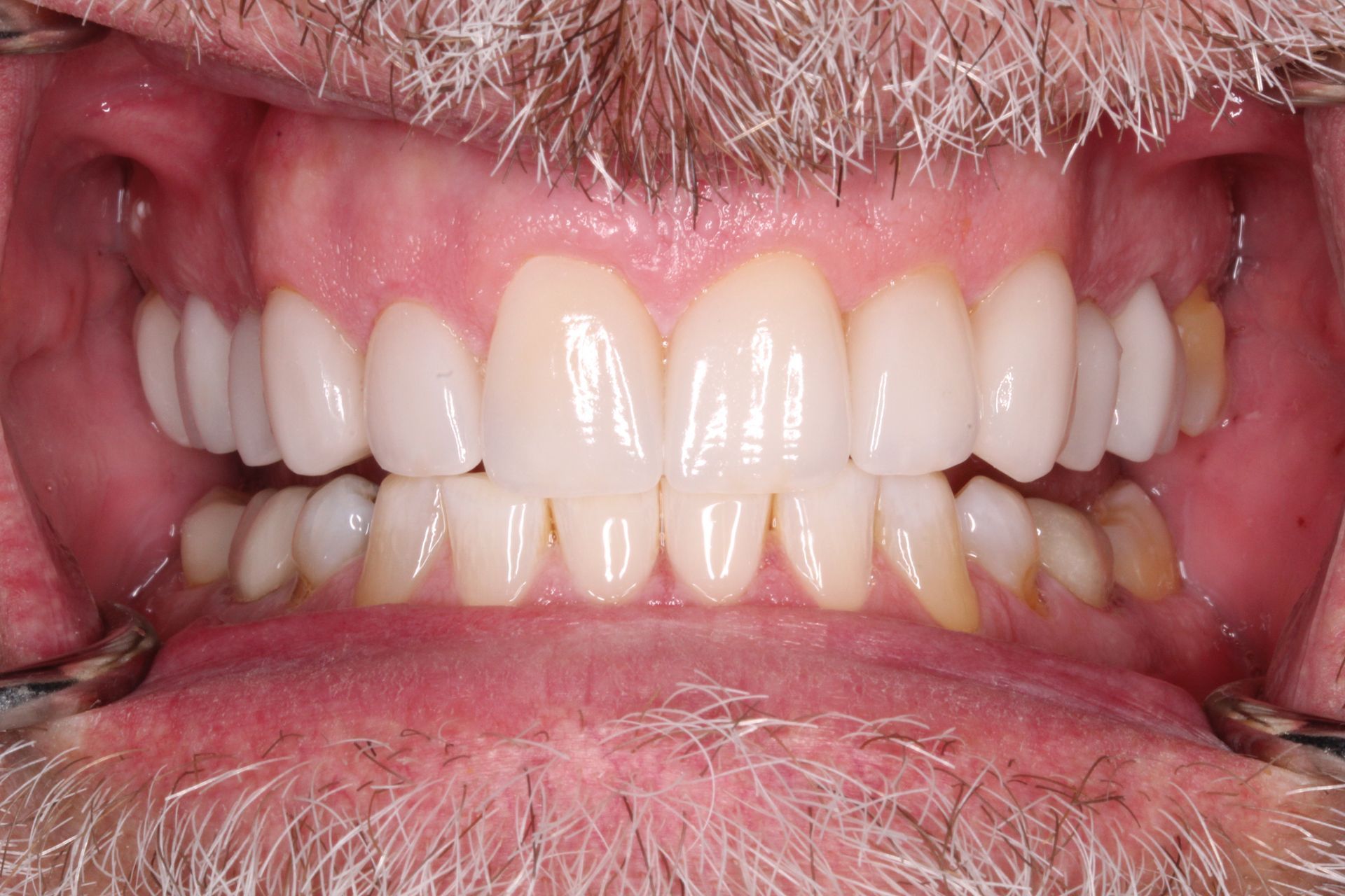 Close-up of a person's mouth showing teeth; upper teeth are white and lower teeth are yellowish.