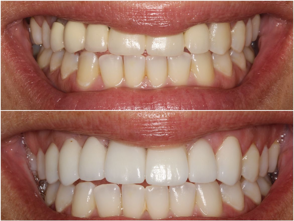 Before and after comparison of teeth whitening; upper teeth before and lower teeth after treatment.