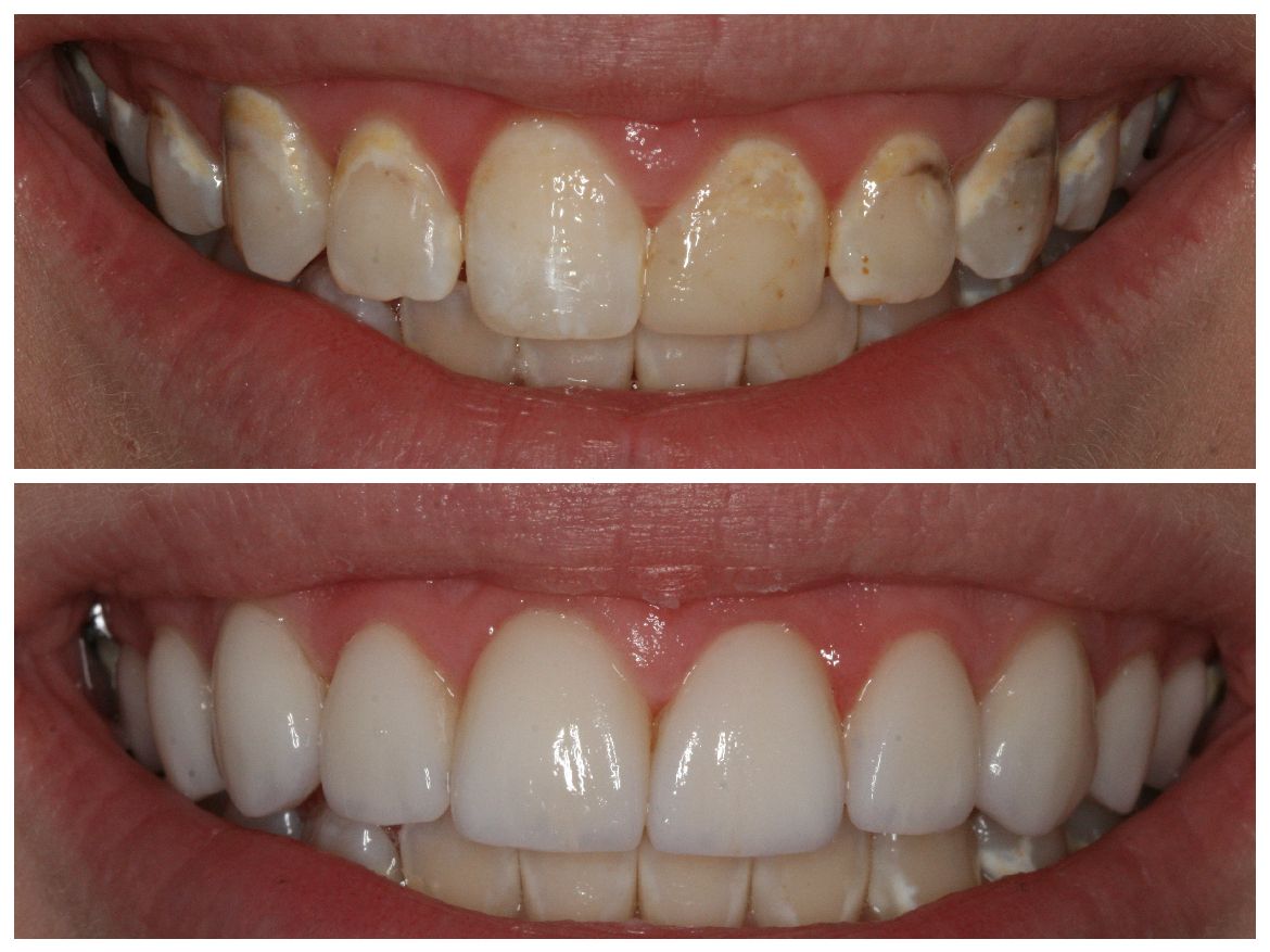 Top: Close-up of stained teeth. Bottom: Close-up of bright, white teeth after a dental procedure.
