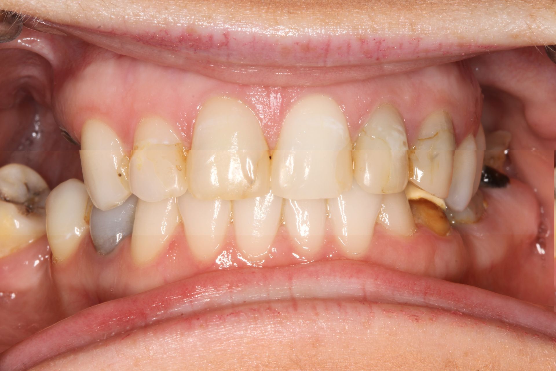 Close-up of human teeth, showing discoloration, cavities, and signs of dental work; pink gums visible.